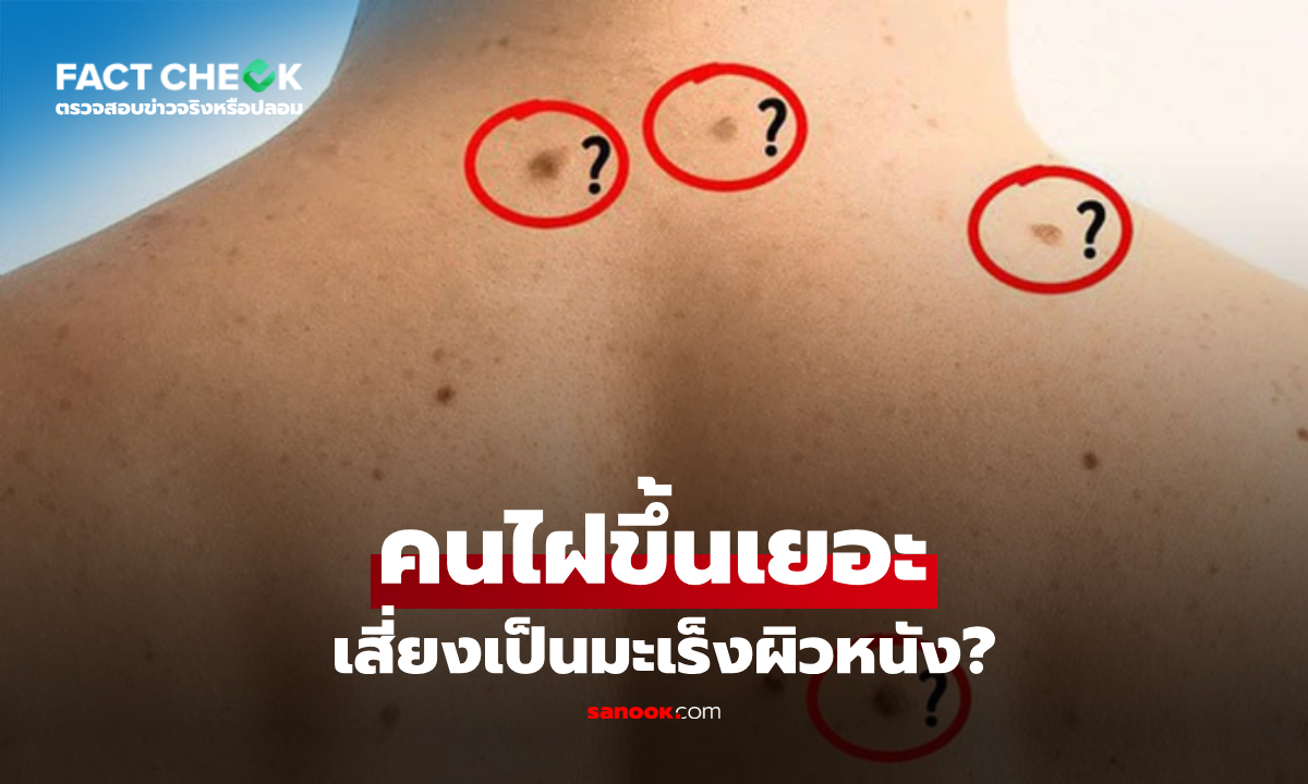 “사마귀가 많으면 ‘피부암’ 발병 위험이 높아진다”는 ...